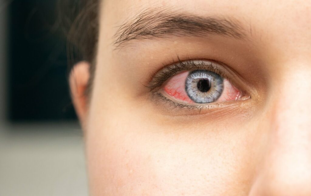 A zoomed in image of a person's eye. The eye is red, irritated, and swollen from pink eye or another condition.