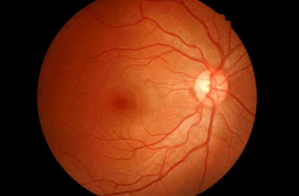 An retinal image displaying the optical nerve and the rest of the eye's interior.