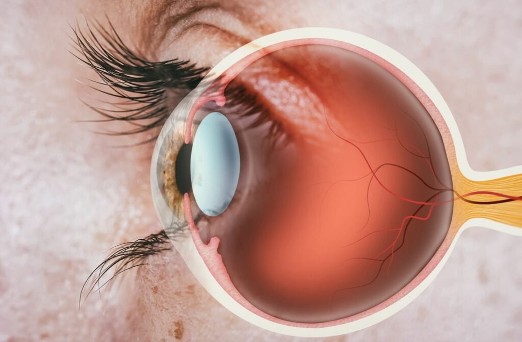 Illustration of eye anatomy showing blood vessels and optic nerve imposed on an up-close photograph of a real eye.