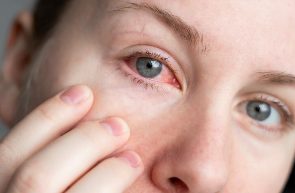 Close-up of a person’s eye showing visible redness and irritation, with their fingers gently pulling down the lower eyelid.